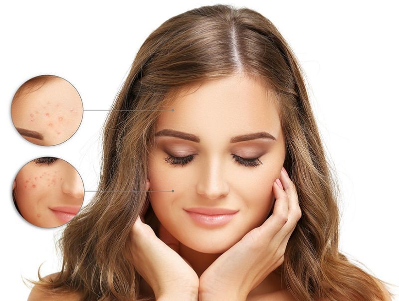 Đặt vấn đề về mụn